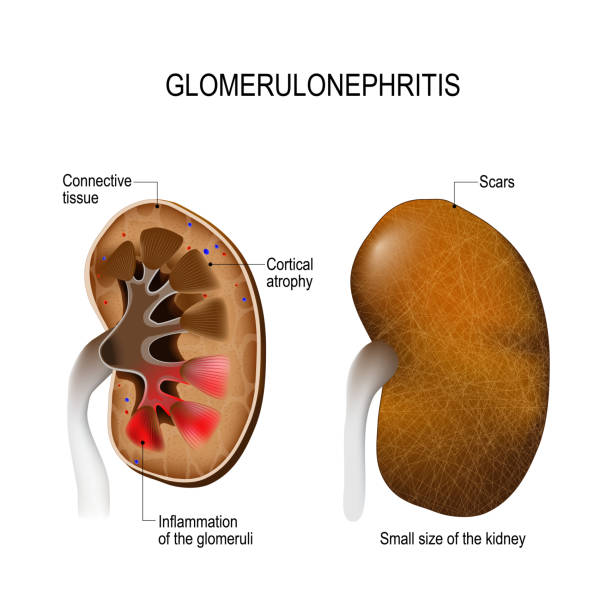 Glomerulonephritis